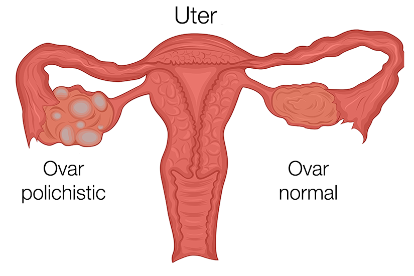 Ce sunt ovarele monopolichistice - Dr Diana Mihai medic ginecolog bucuresti infertilitate